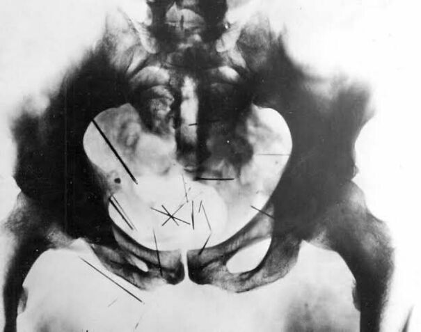 An X-Ray Of The Pelvis Of Albert Fish Reveals Needles He Had Inserted Into His Pelvic Area For Pleasure