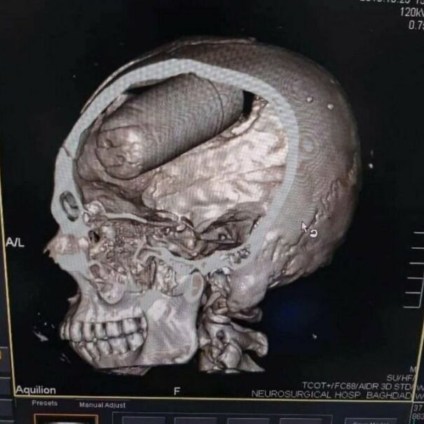 This X-Ray Reveals A Tear Gas Canister That Was Fatally Embedded In A Protester’s Brain During Anti-Government Protests In Iraq In 2019