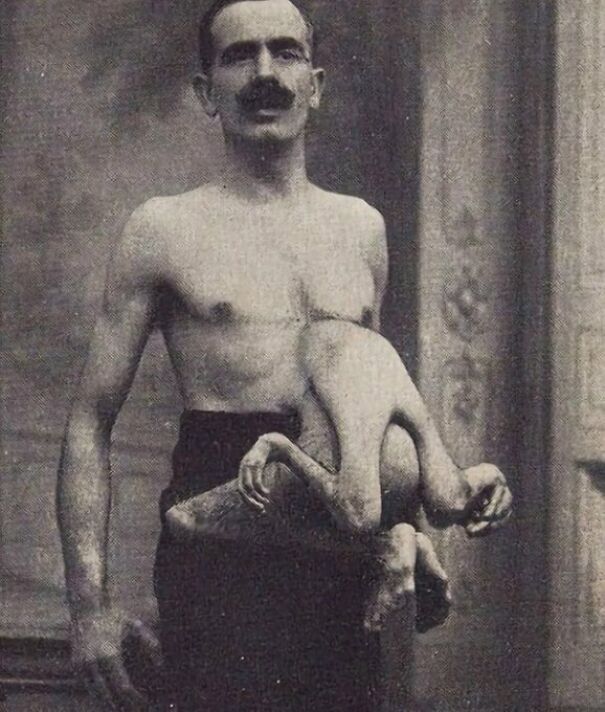 Jean Libbera, Aka “The Double-Bodied Man,” Had His Parasitic Brother, Jacques Libbera, Connected To Him From His Chest-Stomach Area