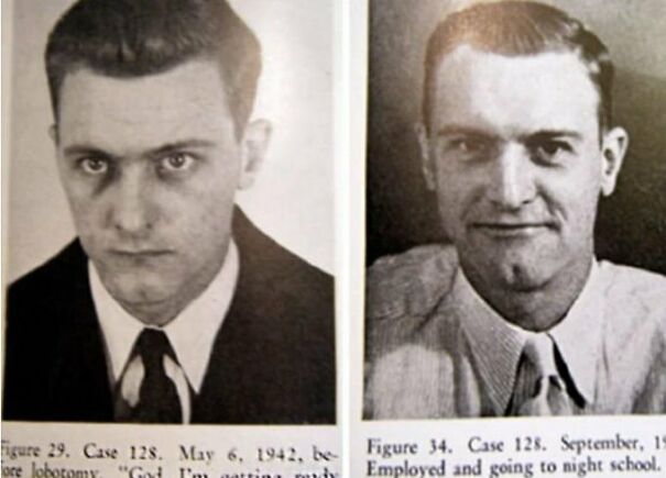 Picture Of A Man With Schizophrenia Before And After His Lobotomy