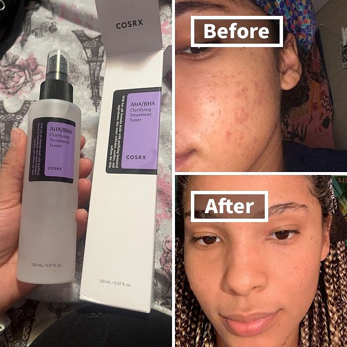 This COSRX Aha/Bha Clarifying Treatment Toner Is The One-Step Solution For Achieving A Healthy, Balanced Glow – It Gently Exfoliates And Refines Your Pores With A Refreshing Mist