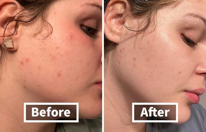 Before: Dull, Tired Skin Showing The Wear And Tear Of Daily Life After: This Dynamic Duo Of Tree Of Life Face Serums Works Its Magic, Revealing A Brighter, Firmer, And More Hydrated Complexion That Radiates Youthful Energy