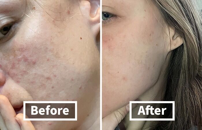 Before: Breakouts That Are Harsher Than A Reality TV Show Elimination After: Pharmaceutical Grade Acne Soap Enters The Scene, Banishing Blemishes And Restoring Your Skin's Confidence