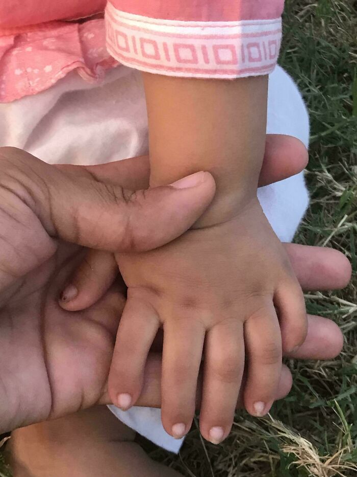 My Niece Has 6 Fingers On Both Hands [oc]