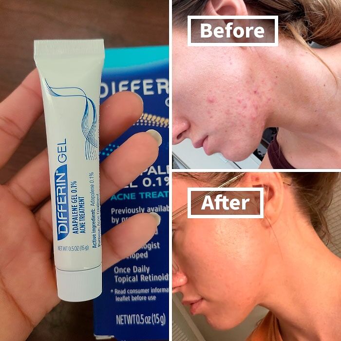 Clear Skin Ahead! Differin Acne Treatment Gel Is Like A 'Glow Up' Potion For Your Face - Bye-Bye Breakouts!