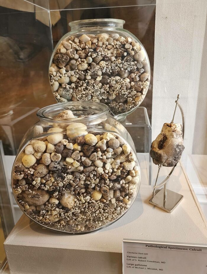 These Jars In A Surgery Museum Are Full Of Gallstones And Kidney Stones