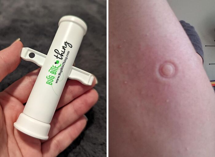 Itch, Begone! This Bug Bite Relief Suction Tool Sucks The Sting Right Out Of Those Pesky Bites