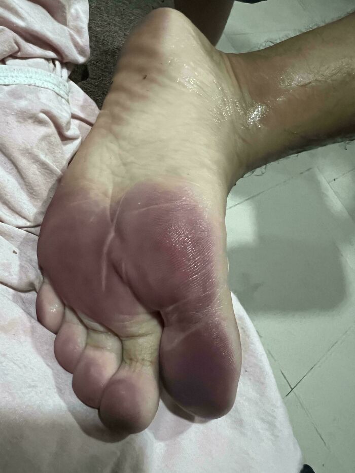 Part Of My Boy’s Soles Turned A Deep Purple