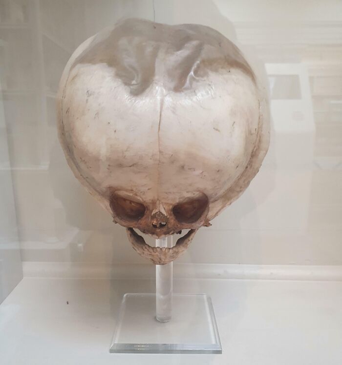 19th Century Skull From A Hydrocephalic Fetus, Royal College Of Surgeons' Museum, Edinburgh