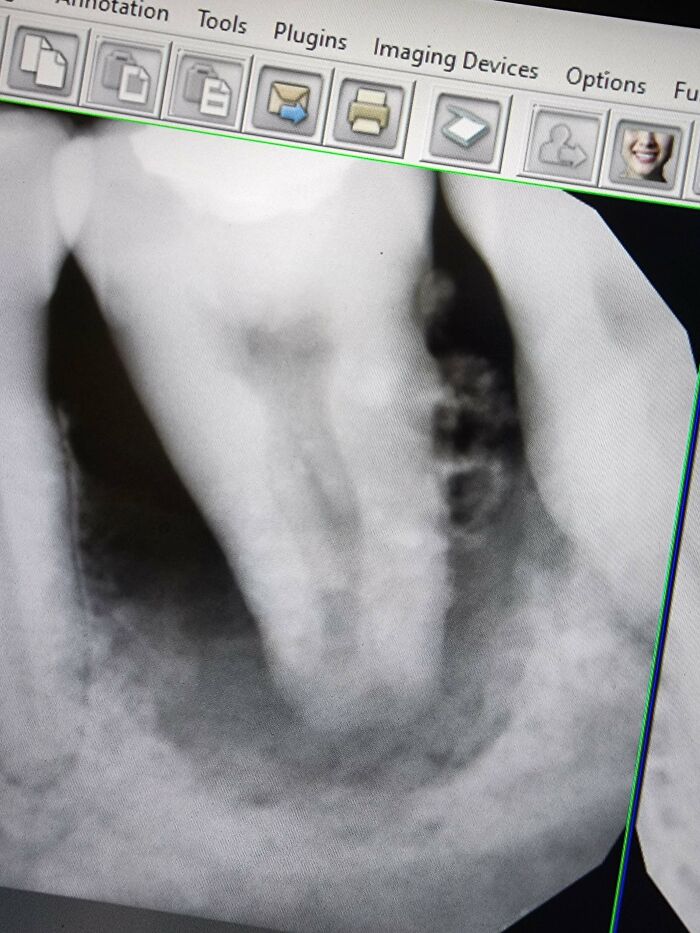 Large Build Up Under The Gums, Tooth Looked Like It Had Barnacles