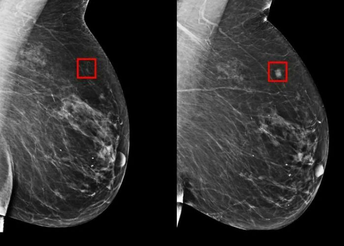 Artificial Intelligence Detects Breast Cancer 5 Years Before It Develops