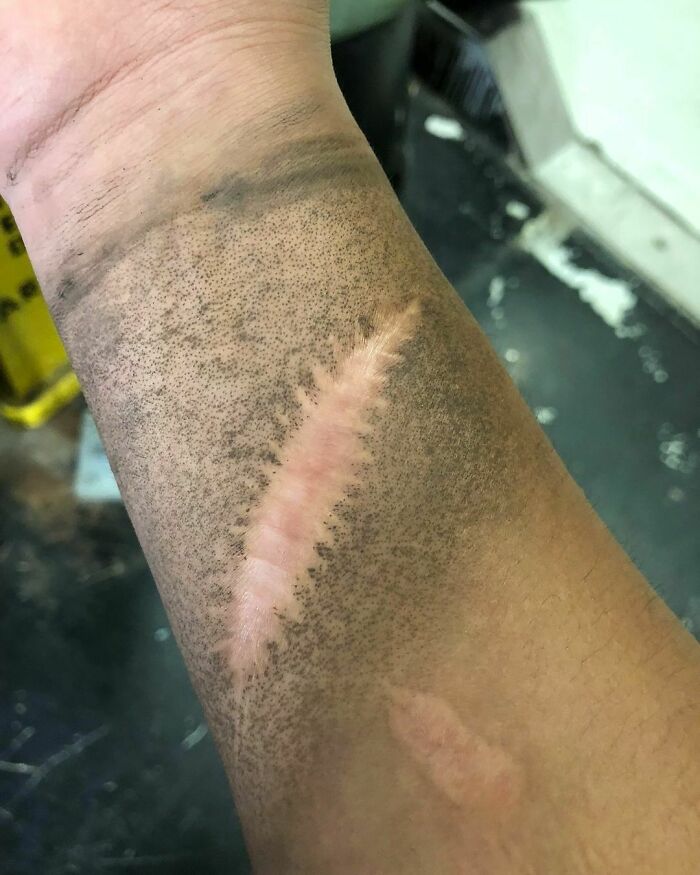 For Some People, Scars Can’t Get Dirty. Scar Skin Tissue Isn’t Like Normal Skin Tissue, And It Doesn’t Regenerate With Sweat Glands. As A Result, No Dirt Will Stick To It