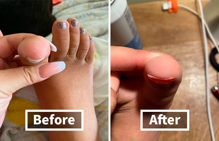 An Ingrown Toenail Correction Kit Is The Pain-Free Path To Happy Toes, Gently Coaxing Those Stubborn Nails Back Into Alignment So You Can Finally Ditch The Discomfort And Rock Those Sandals With Confidence