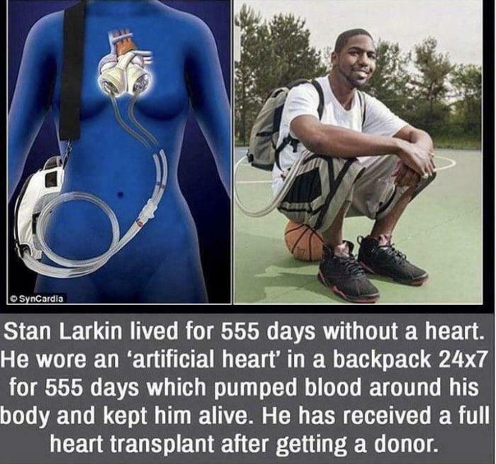 This Man Lived For 555 Days Without A Heart