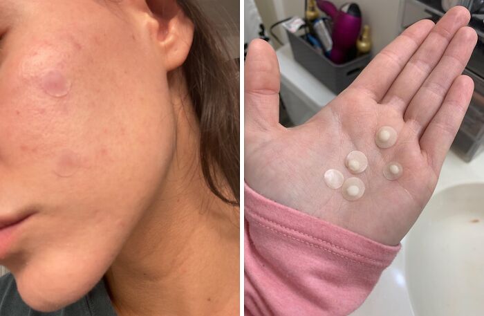 Zits And Blemishes? Consider Them Patched! These Le Gushe K-Beauty Pimple Patches Are The K-Beauty Secret To Clearer Skin