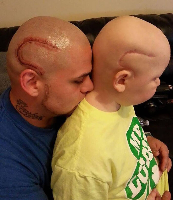 A Father Made A Scar Tattoo On His Head To Support His Sick Son