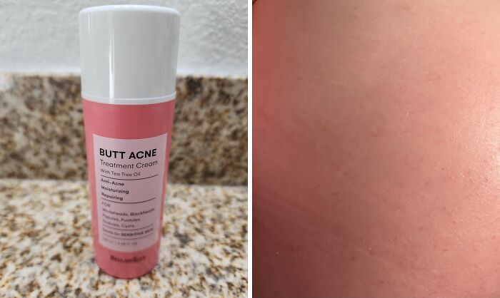 Booty Breakouts Got You Down? This Butt Acne Clearing Lotion Is Here To Save Your, Well, You Know