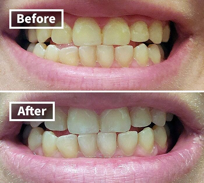 &ldquo;Teeth whitening results before and after; ideal for delivery in a plain brown box.&quot;