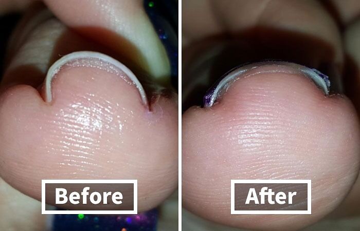 Embarrassed About Your Ingrown Toenails? We Get It. That's Why This Ingrown Toenail Home Treatment Is The Perfect Solution For A Little DIY Foot TLC