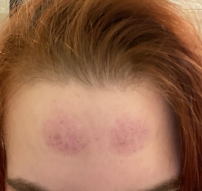 "I didn’t think the suction cups were that strong on my forehead. I have work today. Is concealer my only hope? I regret this so much." - Able_Distribution209