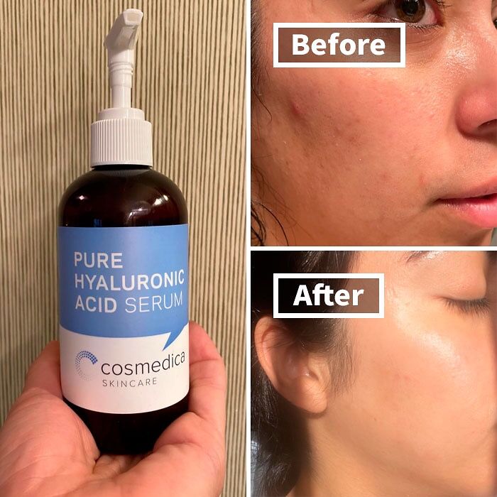 Hydrate, Plump, And Glow: Experience Youthful Skin With This Pure Hyaluronic Acid Serum!