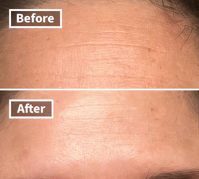 Botox? Nah. These Wrinkle Patches Are The Affordable (And Pain-Free!) Way To Turn Back The Clock On Your Forehead