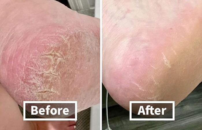 Say "Goodbye" To Sandpaper Feet And "Hello" To Baby-Soft Heels With This Cracked Heel Repair Balm