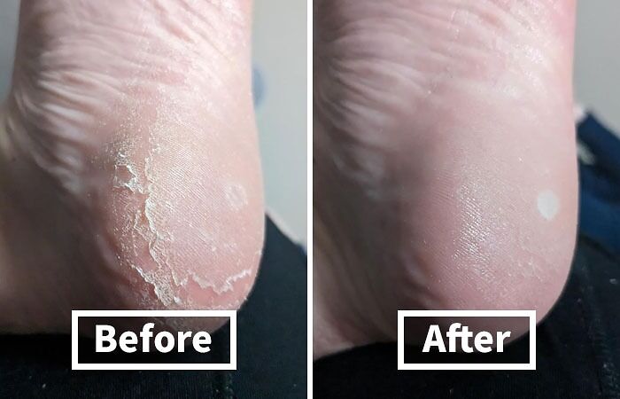 Say Goodbye To Rough, Cracked Heels And Hello To Silky-Smooth Feet With This Colossal Foot Rasp