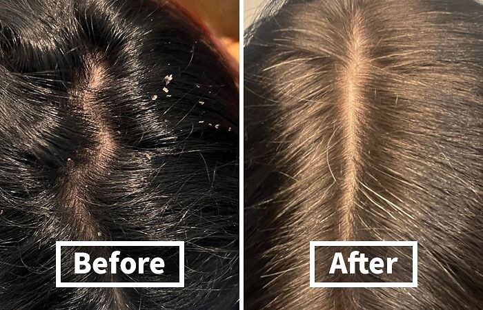 Snow On Your Shoulders, But It's Not December? This Anti-Dandruff Shampoo Will Have Your Scalp Flake-Free And Ready For Any Season