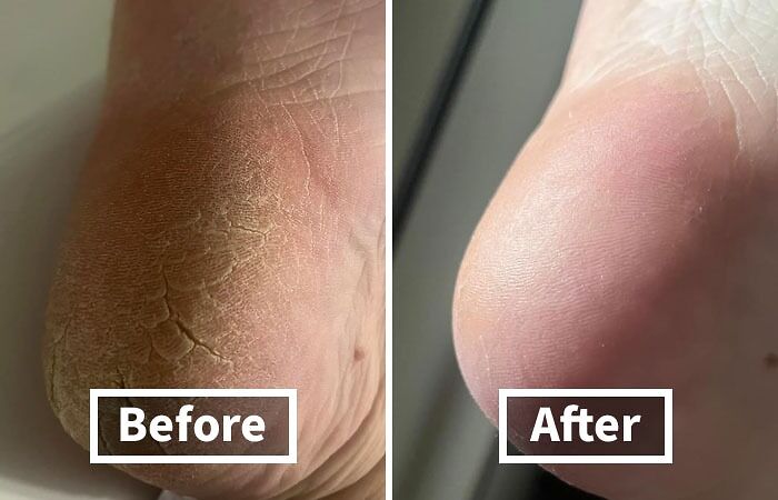 Calluses Got You Feeling Like You've Been Walking On Hot Coals? Cool Down And Smooth Out Those Rough Patches With This Foot File And Callus Remover