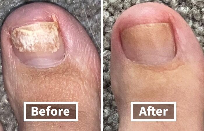 Nail Fungus Got Your Toes Looking Like A Science Experiment Gone Wrong? This Kerasal Nail Renewal Will Have Them Looking Healthy And Sandal-Ready In No Time! 