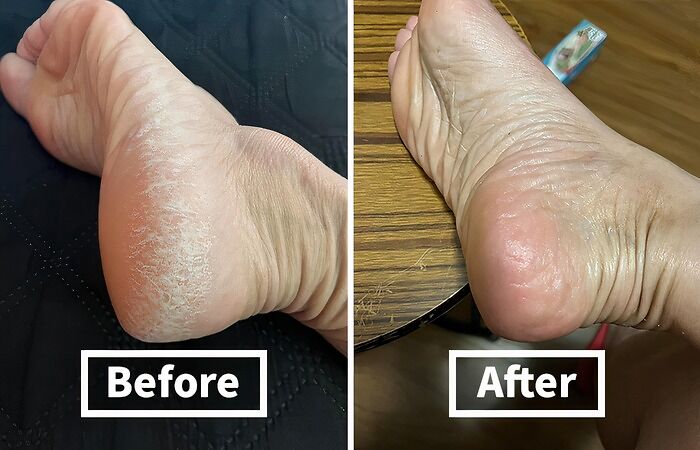 Calluses Got Your Feet Feeling Like Sandpaper? Say 'Adios' To Rough Patches With This Callus Remover Gel 