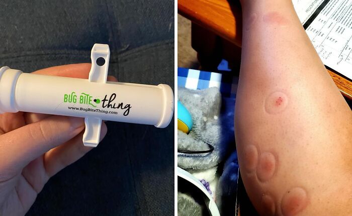 Mosquitoes Got You Itching Like Crazy? The Bug Bite Thing Will Suck The Itch Away