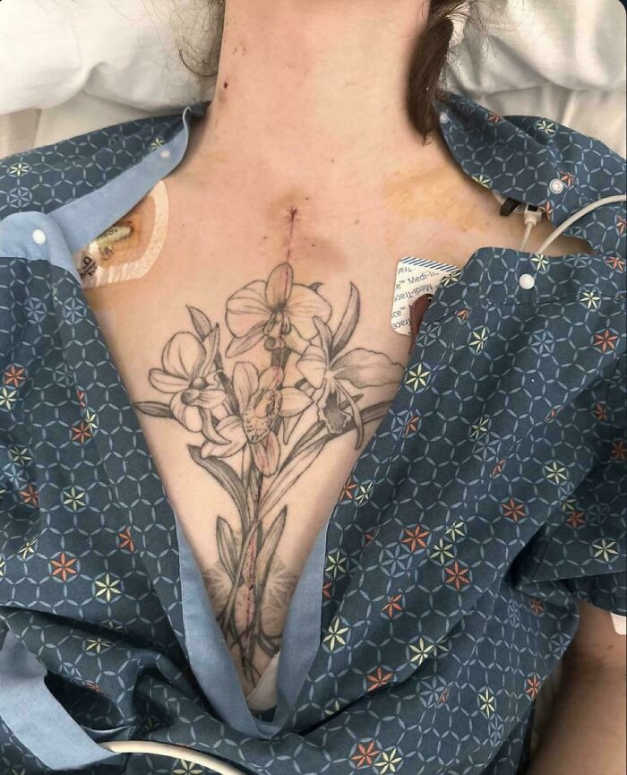 Patient with a floral chest tattoo and medical scar, showcasing the human body's resilience in recovery.