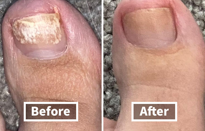 Nail Problems Got You Hiding Your Toes In Shame? We've All Been There. Thankfully, Kerasal Nail Renewal Exists