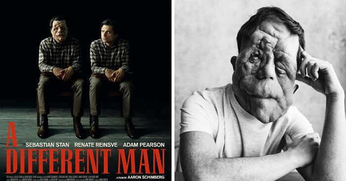 “My Disability Has Opened Doors”: Actor Adam Pearson Wants To Normalize Facial Disfigurement