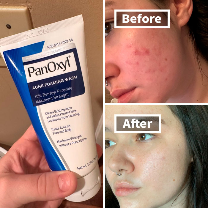 Clear Skin Starts Here: Powerful Panoxyl Acne Foaming Wash For Breakout-Free Beauty!