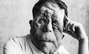 “My Disability Has Opened Doors”: Actor Adam Pearson Wants To Normalize Facial Disfigurement