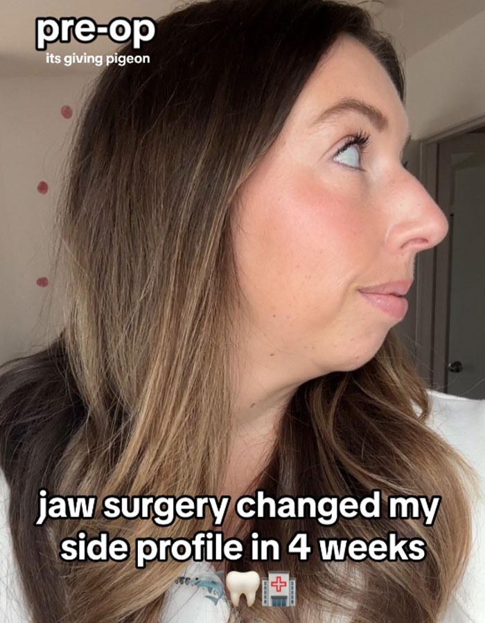 Woman Stuns Viewers With Surgery Results After Having Her “Jaw Of An 80-Year-Old” Fixed