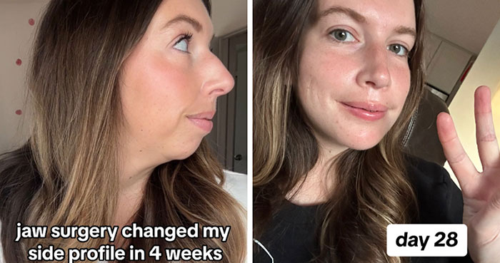 Woman Stuns Viewers With Surgery Results After Having Her “Jaw Of An 80-Year-Old” Fixed