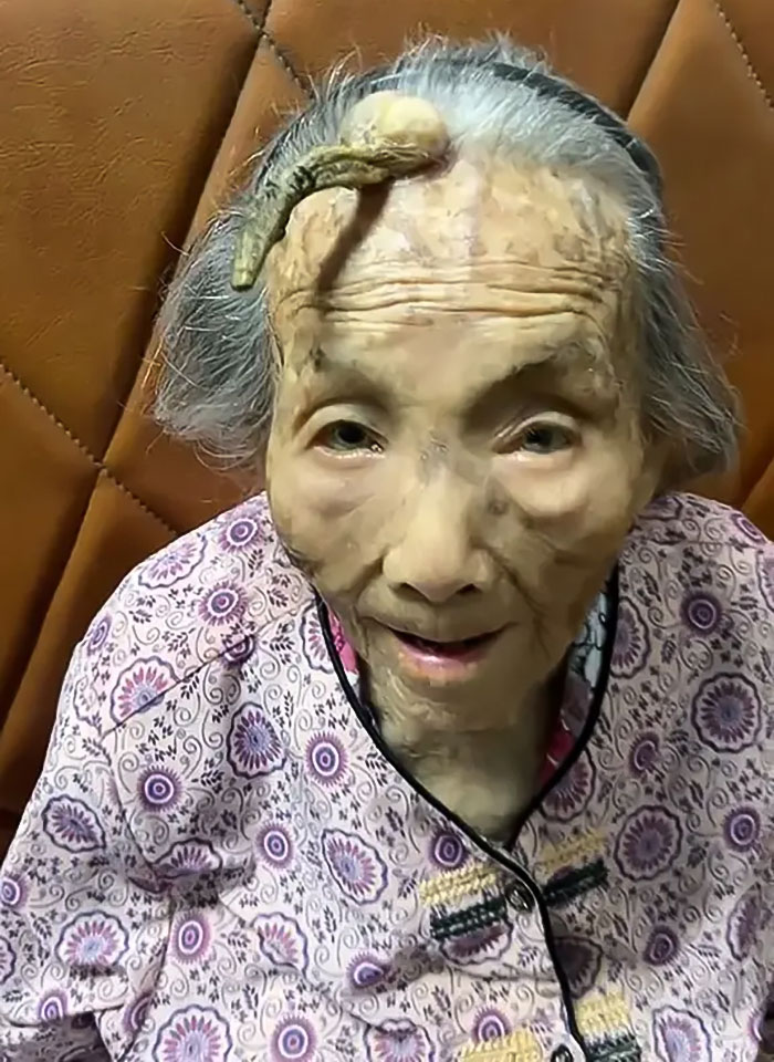 "It's Too Risky": 107YO Goes Viral For 4-Inch "Longevity Horn" Growing From Her Forehead