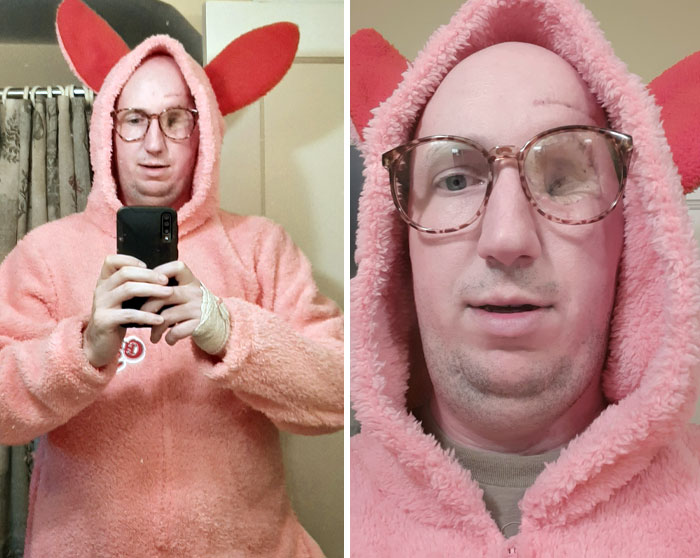 Cancer Took My Eye Last Month But Not My Sense Of Humor. I Was Ralphie (A Christmas Story) For Halloween. You'll Shoot Your Eye Out