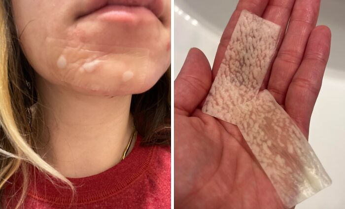 Zap Zits Into Oblivion With These Genius Mighty Patch Pimple Patches - A Discreet And Effective Solution That Draws Out Impurities And Reduces Inflammation