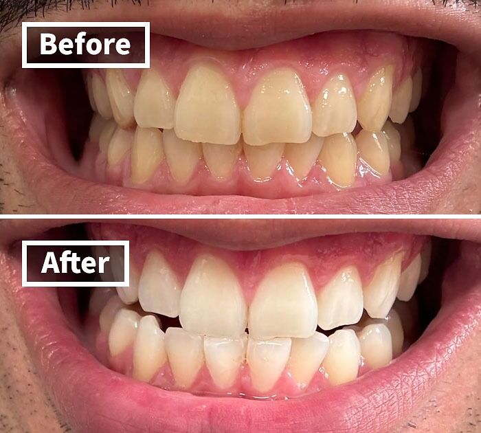  Crest 3D Whitestrips Gives You That Hollywood Smile Without The Hollywood Pricetag