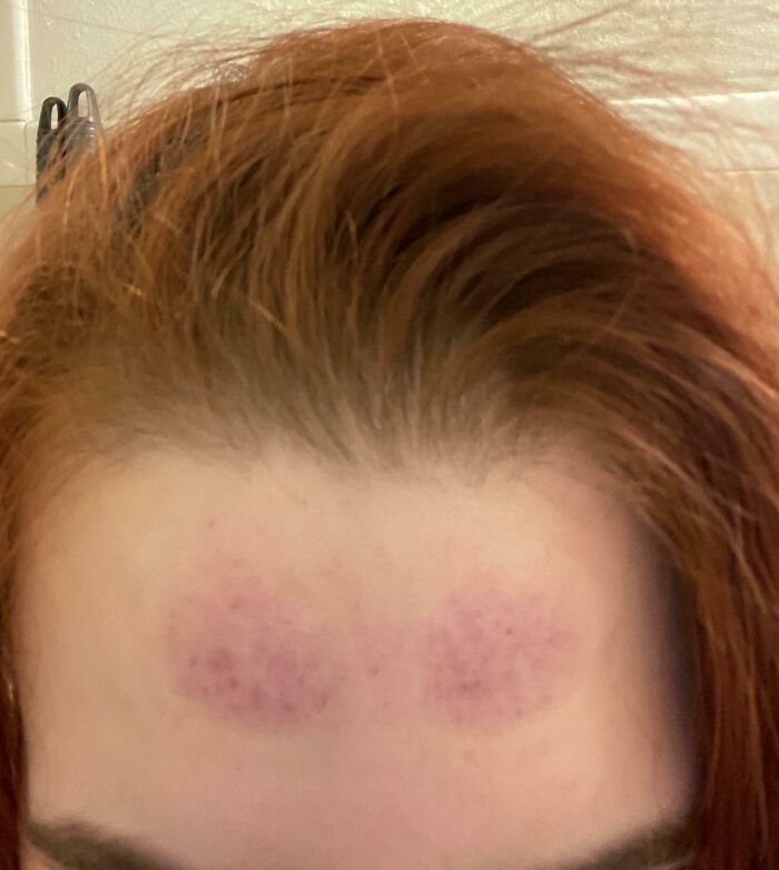 I Didn’t Think The Suction Cups Were That Strong On My Forehead. I Have Work Today