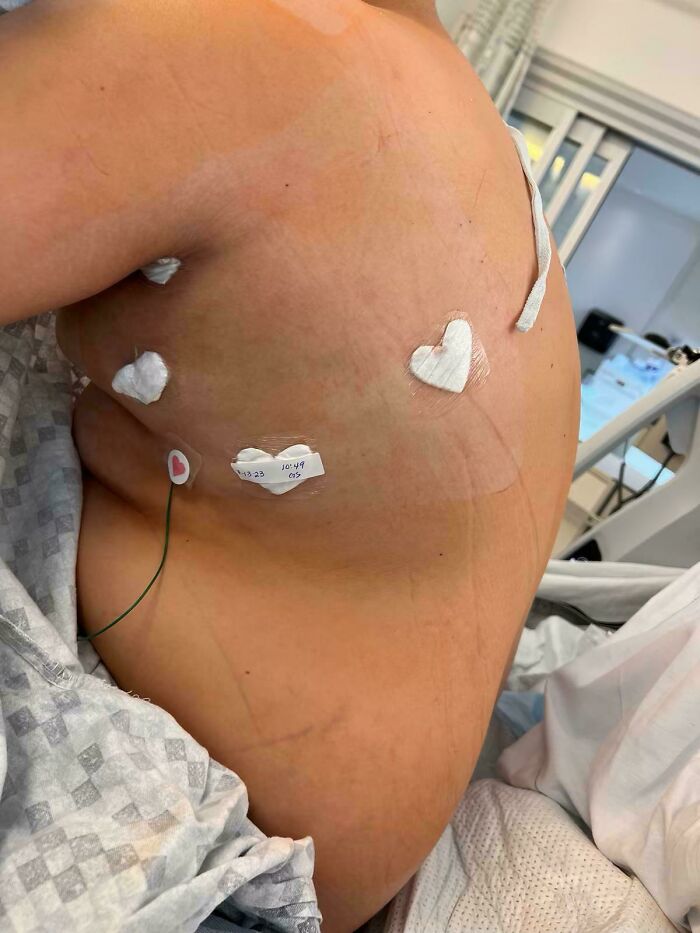 Heart-shaped medical patches on a patient's back in a hospital setting; mildly interesting observation.