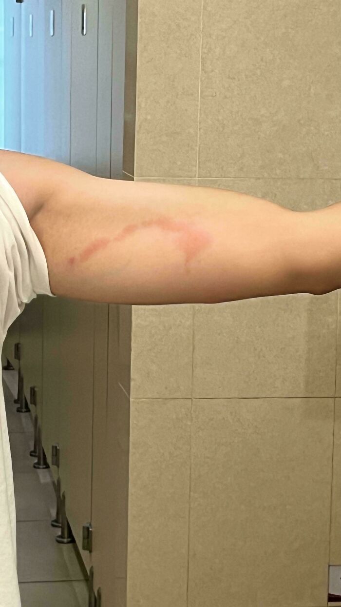 Arm with a unique scar resembling a river, shared for its mildly interesting appearance.