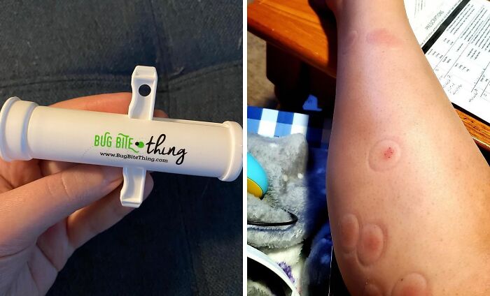 Suck It Up, Bug Bites! Banish Those Pesky Itchy Bumps With This Genius Bug Bite Thing Suction Tool - A Weirdly Wonderful Way To Remove Insect Bites And Leave Your Skin Serene