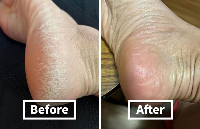 Calluses Got Your Feet Feeling Like You Walked On Hot Coals? This Lee Beauty Professional Callus Remover Will Have Your Feet Smoother Than A Baby's Bottom