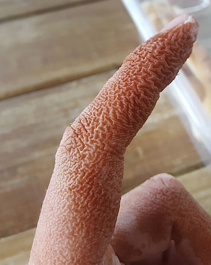 Close-up of a wrinkled finger, showcasing a unique medical case of human body skin texture.